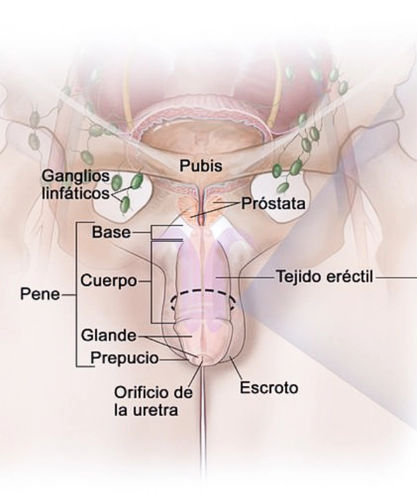 cáncer de pene